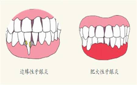 牙龈炎.jpg 牙龈炎.jpg